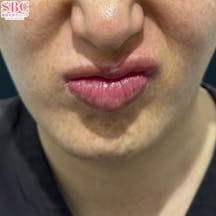 【しわ】ボトックス(アラガン)_before