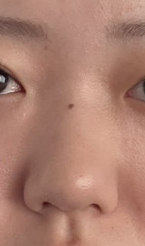 湘南美容クリニック 大阪梅田本院で医療痩身・ダイエット・脂肪溶解注射・BNLS注射を受けたnaagiiさんの写真