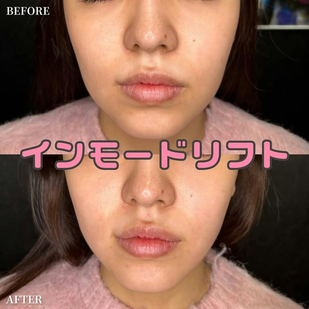 【女性・顔】インモードリフトbefore.after