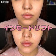 【女性・顔】インモードリフトbefore.after