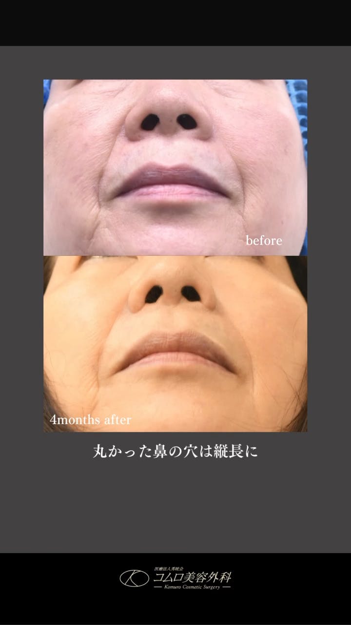 【70代女性・鼻】小鼻縮小術（外側切除）_before_aftar