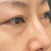 【40代女性・クマ】目の下の切らないクマ・たるみ(ふくらみ)取り、ナチュラル脂肪注射コンデンスリッチ_before