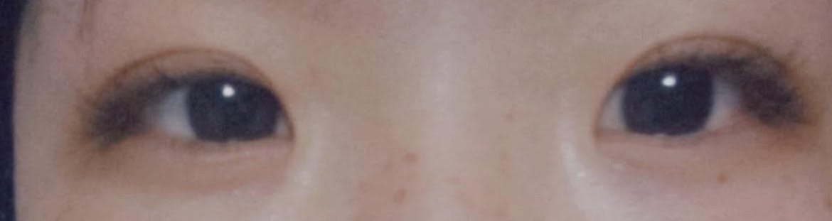エマクリニック(EMMA CLINIC)で目頭・蒙古ひだ切開・目尻切開を受けた朝井萌咲さんの写真