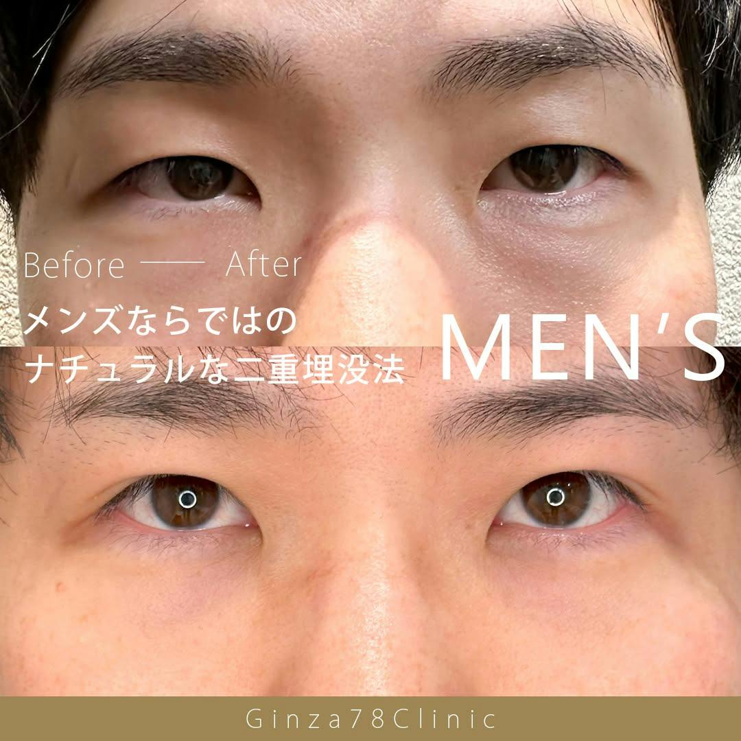 【男性・目元】二重整形(78ロック法)_before_aftar