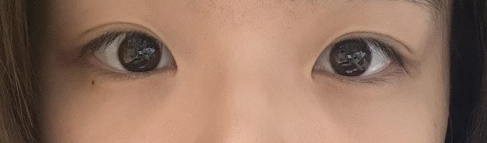 藤井美容外科で二重埋没法：二重埋没法(三点止め、1年保証)を受けたMaちゃんさんの写真