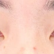 【女性・目元】タルミ取り併用全切開法二重_before