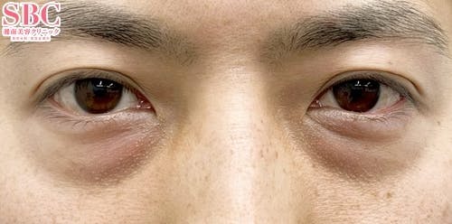 【30代男性・目元】目の下の切らないクマ・たるみ（ふくらみ）取り、ナチュラル脂肪注射ナノリッチ_before