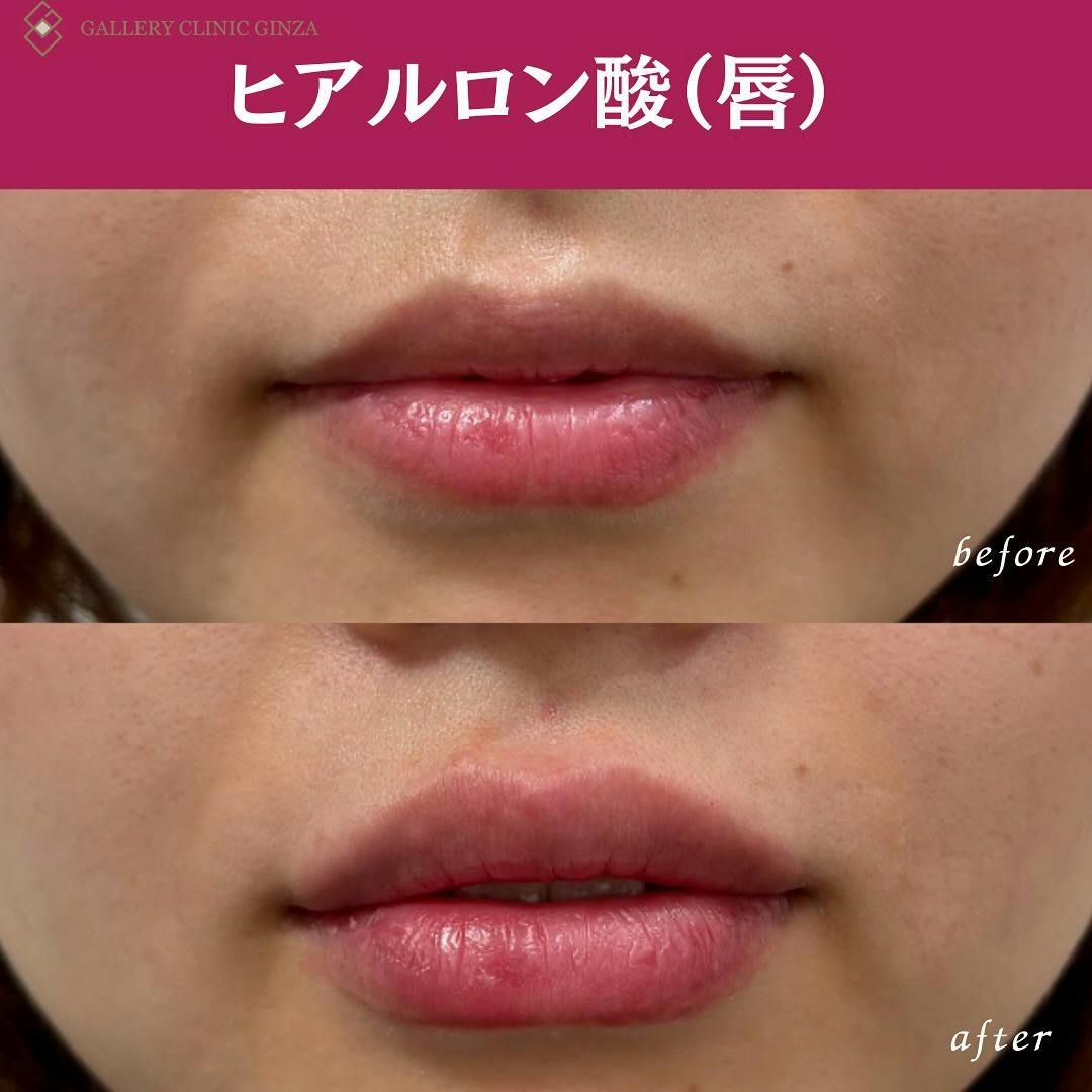 【女性・唇】ヒアルロン酸(唇)_before_aftar