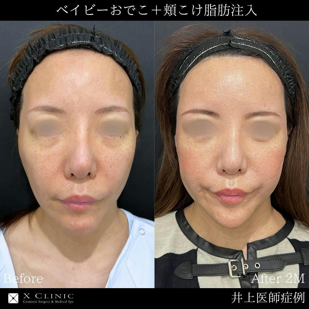 【女性・輪郭】ベイビーおでこ 頬こけ脂肪注入 エクソソーム_before_aftar