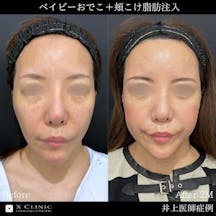 【女性・輪郭】ベイビーおでこ 頬こけ脂肪注入 エクソソーム_before_aftar