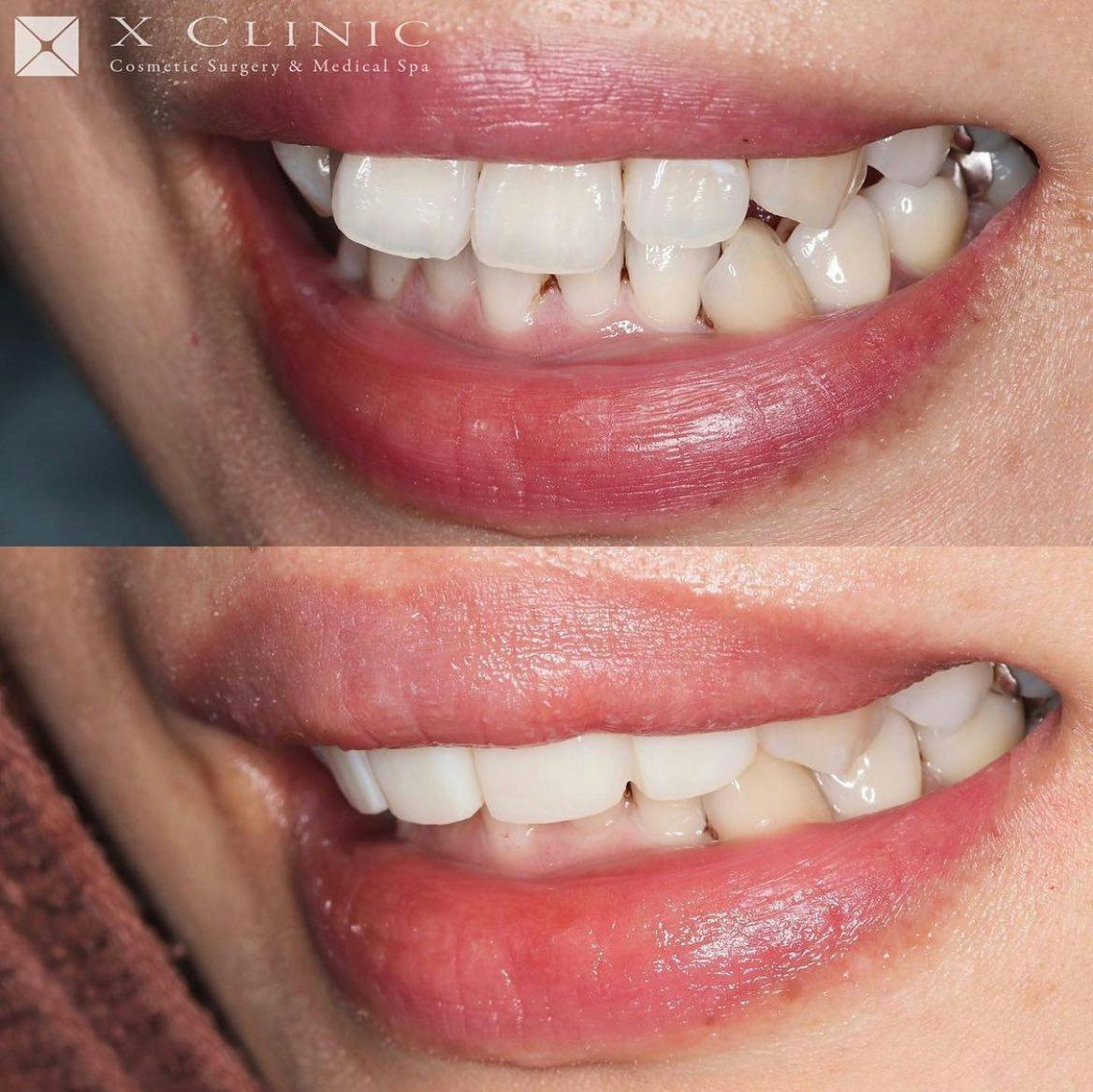 【女性・歯】1dayスピードセラミック 矯正_before_aftar