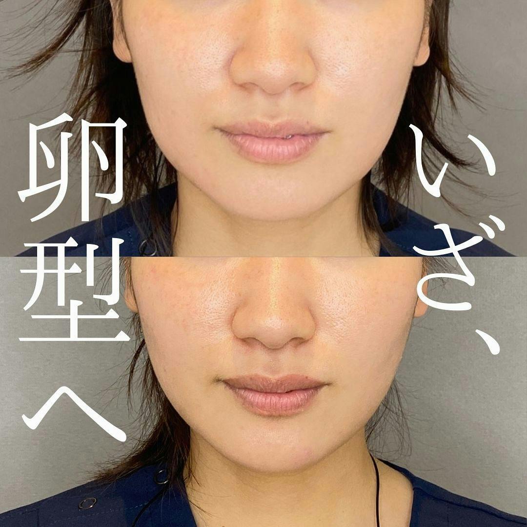 【女性・輪郭】ハイフ・エラボトックス・糸リフト_before_aftar