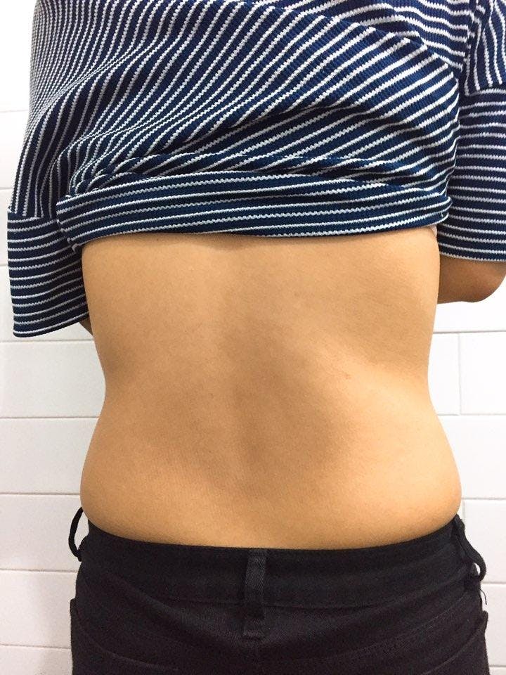 THE CLINIC（ザ・クリニック）大阪院でおなか回り脂肪吸引：脂肪吸引を受けたのりさんの写真