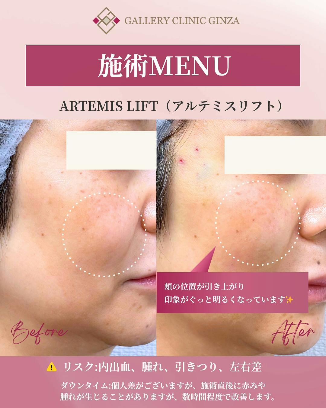 【女性・たるみ】アルテミスリフト_before_aftar