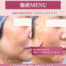 【女性・たるみ】アルテミスリフト_before_aftar