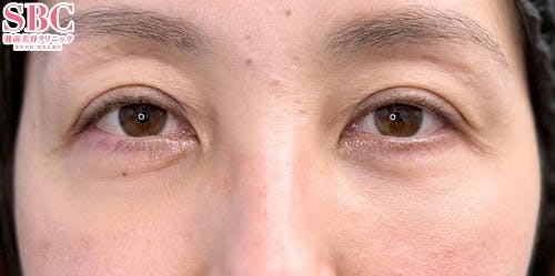 【40代女性・クマ】目の下の切らないクマ・たるみ（ふくらみ）取り、ナチュラル脂肪注射ナノリッチ、ナチュラル脂肪注射コンデンスリッチ_after