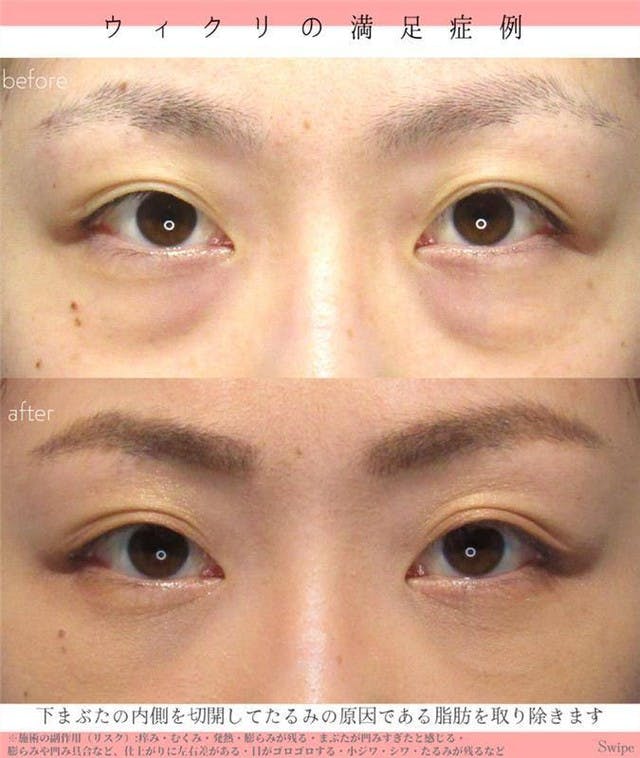 【女性・目元】たるみ_before_aftar