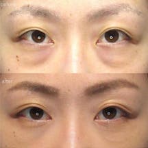 【女性・目元】たるみ_before_aftar