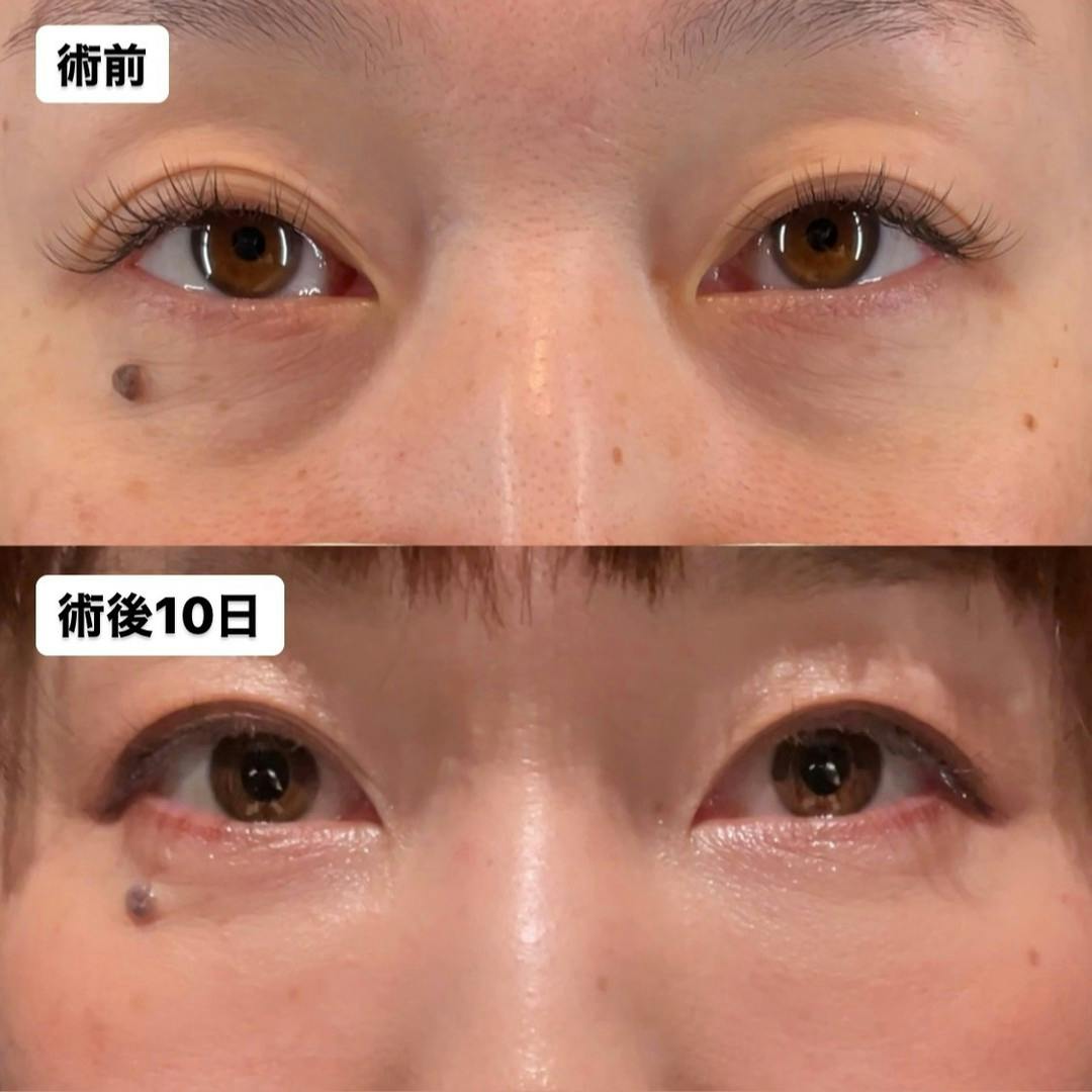 【女性・目元】脂肪注入（目の下からゴルゴ）_before_aftar