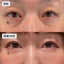 【女性・目元】脂肪注入(目の下からゴルゴ)_before_aftar