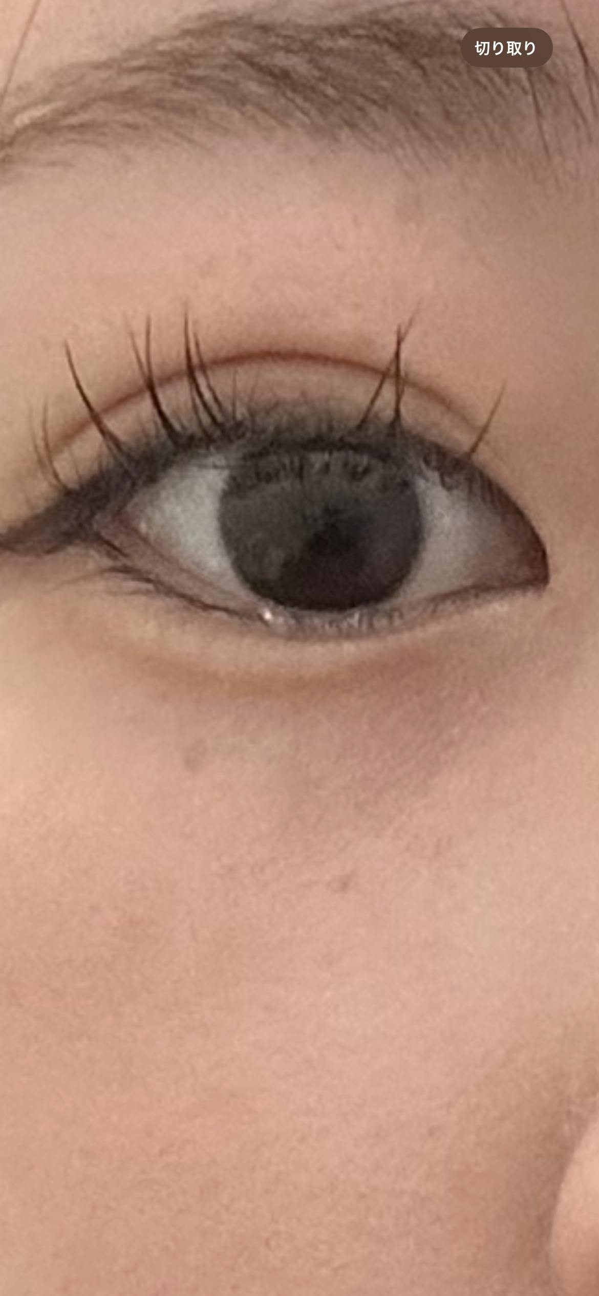 ソルクリニック(SOL CLINIC)で涙袋ヒアルロン酸:涙袋ヒアルロン酸 0.3c cを受けたレイレイさんの写真