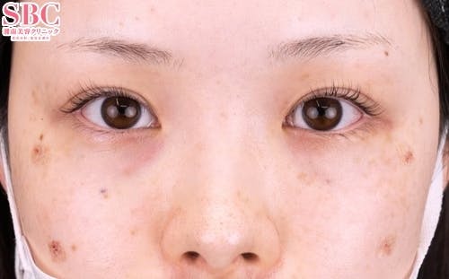 【20代女性・目元】ナチュラル脂肪注射コンデンスリッチ、目の下の切らないクマ・たるみ（ふくらみ）取り_justafter