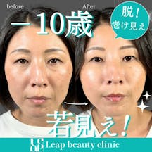 【40代女性・顔】糸リフト・目の下のたるみ取り・ヒアルロン酸・スネコス注射_before_aftar