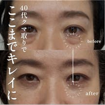 【40代女性・クマ】経結膜脱脂法_before_aftar