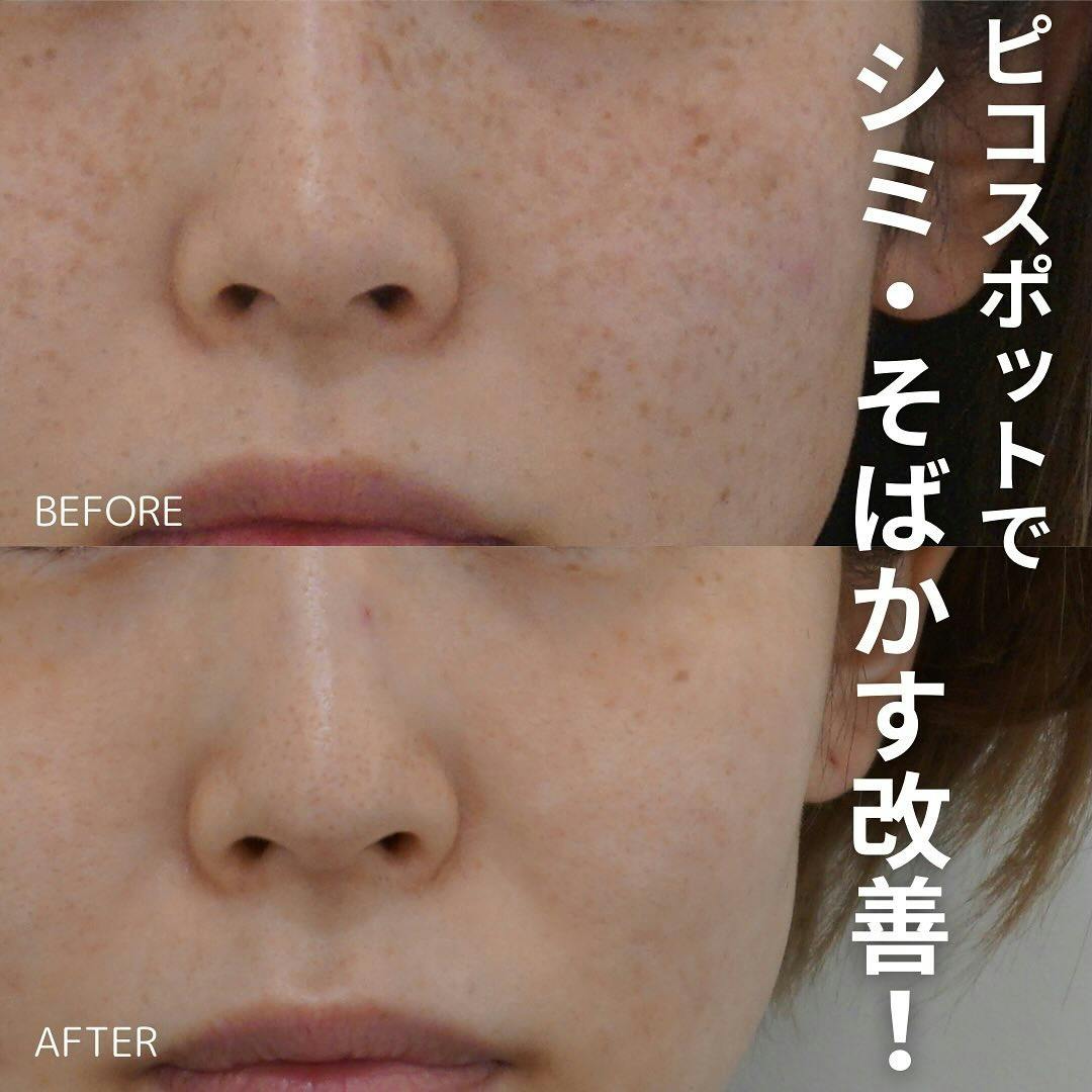 【女性・シミ】ピコスポット_before_aftar