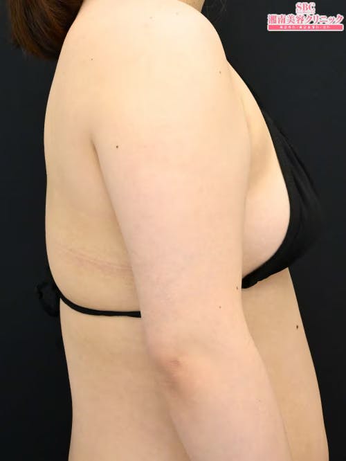 【20代女性・二の腕】クールスカルプティング(R)・ エリート（クルスカダブル） サクセンダ_before