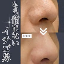 【男性・毛穴】PRPダーマペン(鼻)_before_aftar