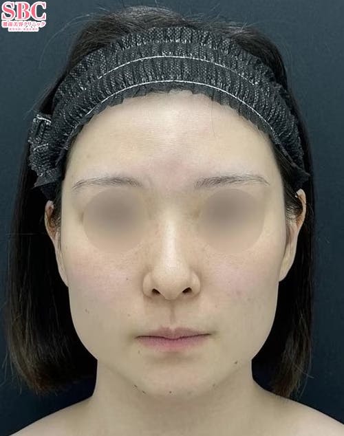 【20代女性】小顔用脂肪吸引注射・バッカルファット除去・糸リフト・その他の治療法_before