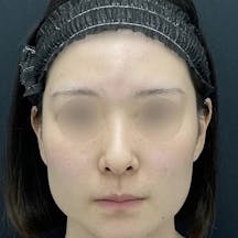 【20代女性】小顔用脂肪吸引注射・バッカルファット除去・糸リフト・その他の治療法_before