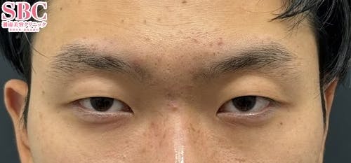 【20代男性・目元】線留めクロス二重術_before