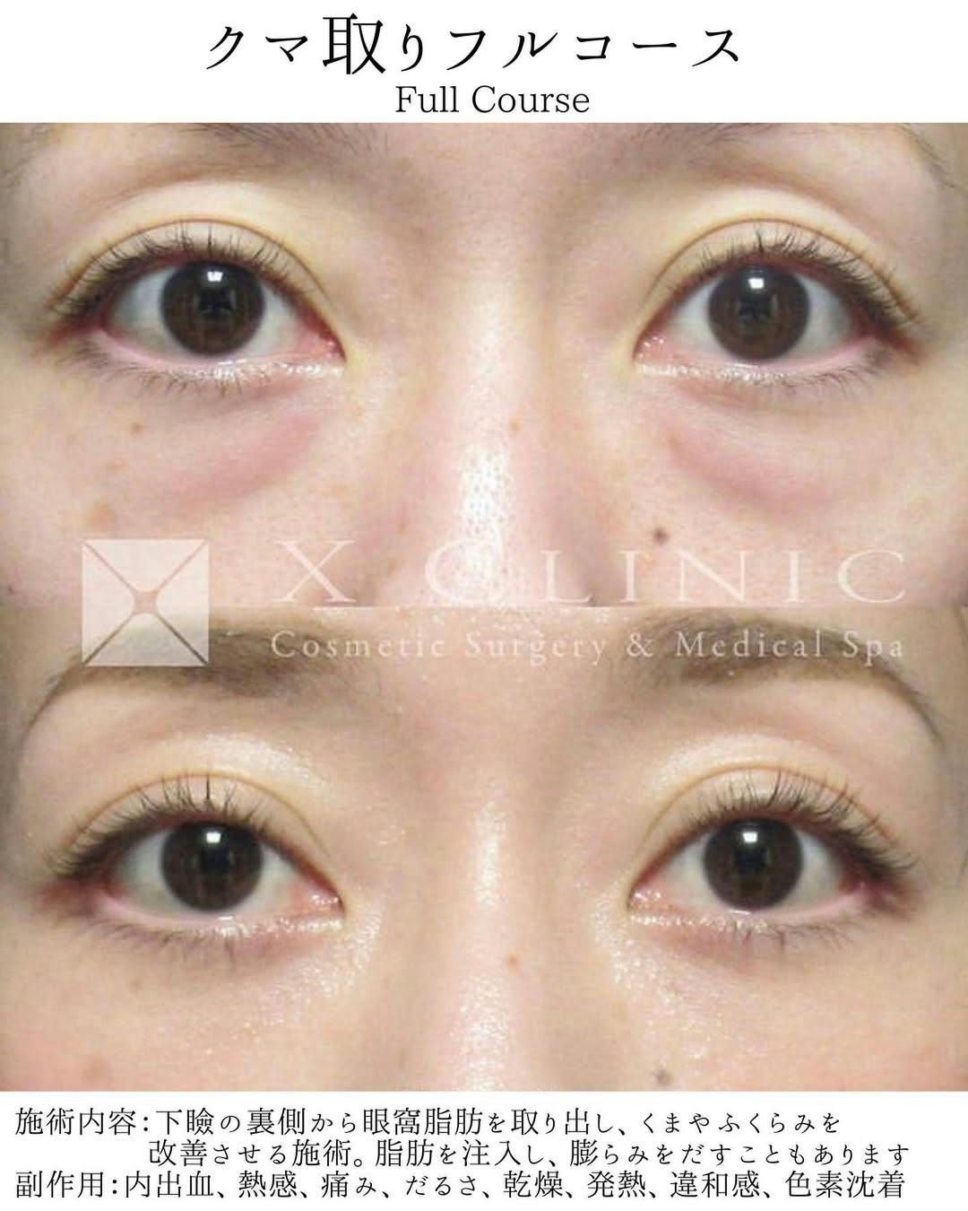 【女性・目元】クマ取りフルコース_before_aftar