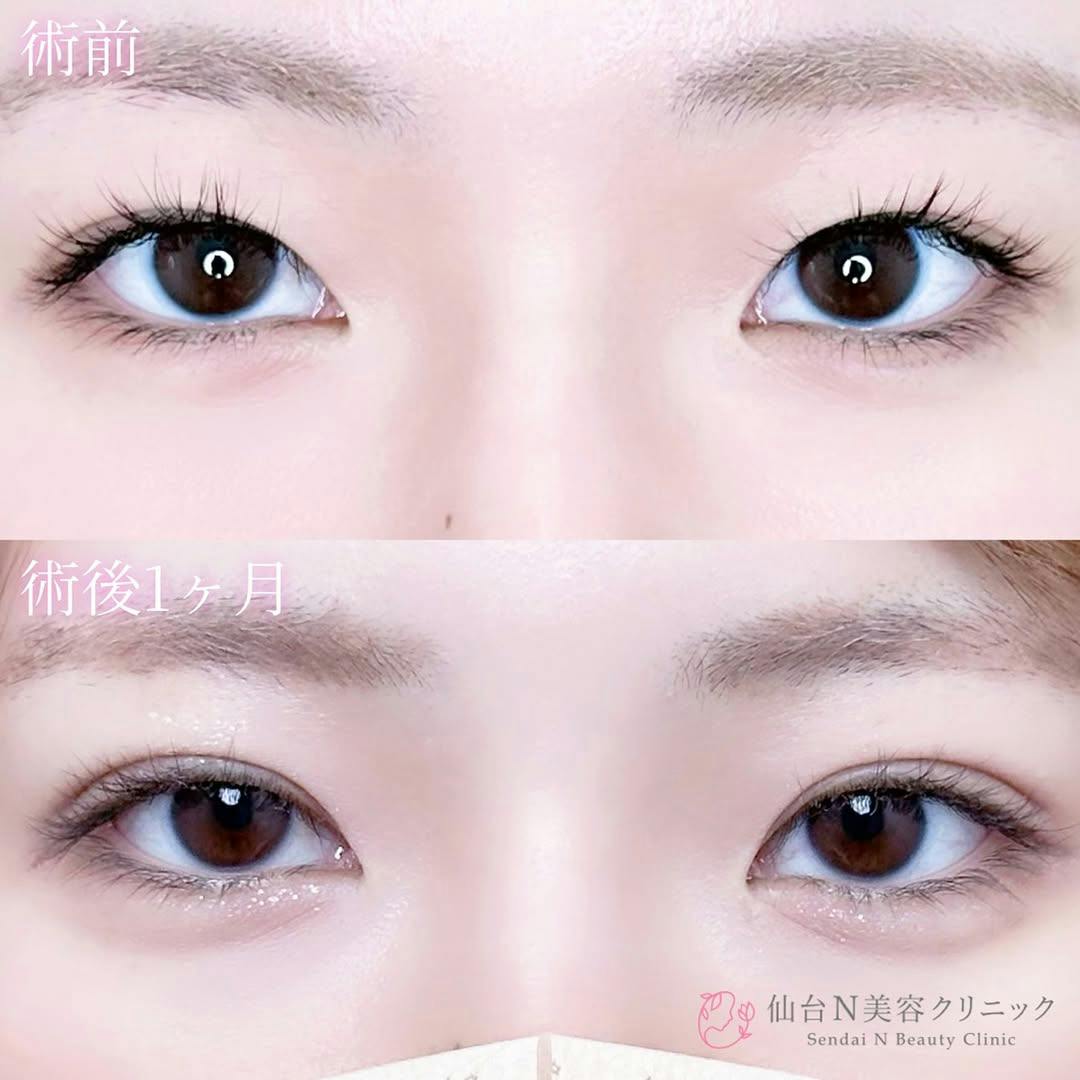 【女性・目元】二重埋没法（シークレットトリプル）_before_aftar