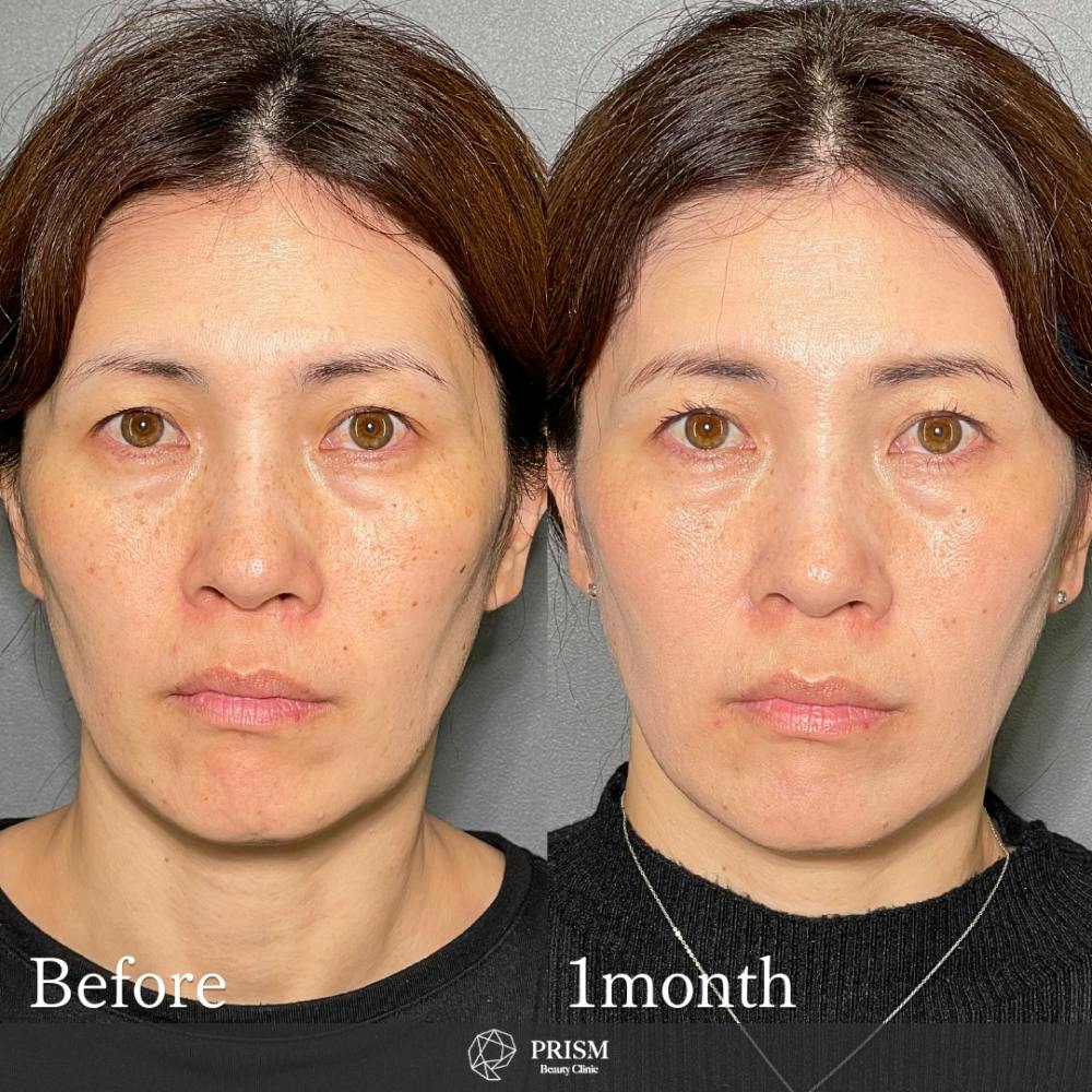 【40代女性・顔】美人レーザー(MIINレーザー) 【トーニング】【コラーゲントーニング】【スポット シミ取り放題】_before_aftar