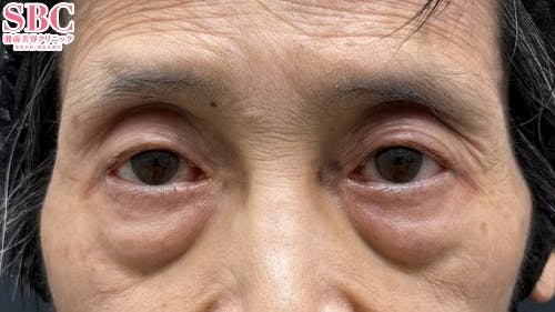 【70代女性・目元】眼瞼下垂＋二重 タルミ取り併用全切開法二重_before
