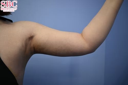 【32歳女性・二の腕】根こそぎVASER脂肪吸引、ライポマティック脂肪吸引、Aquicell（アキーセル）脂肪吸引_aftar