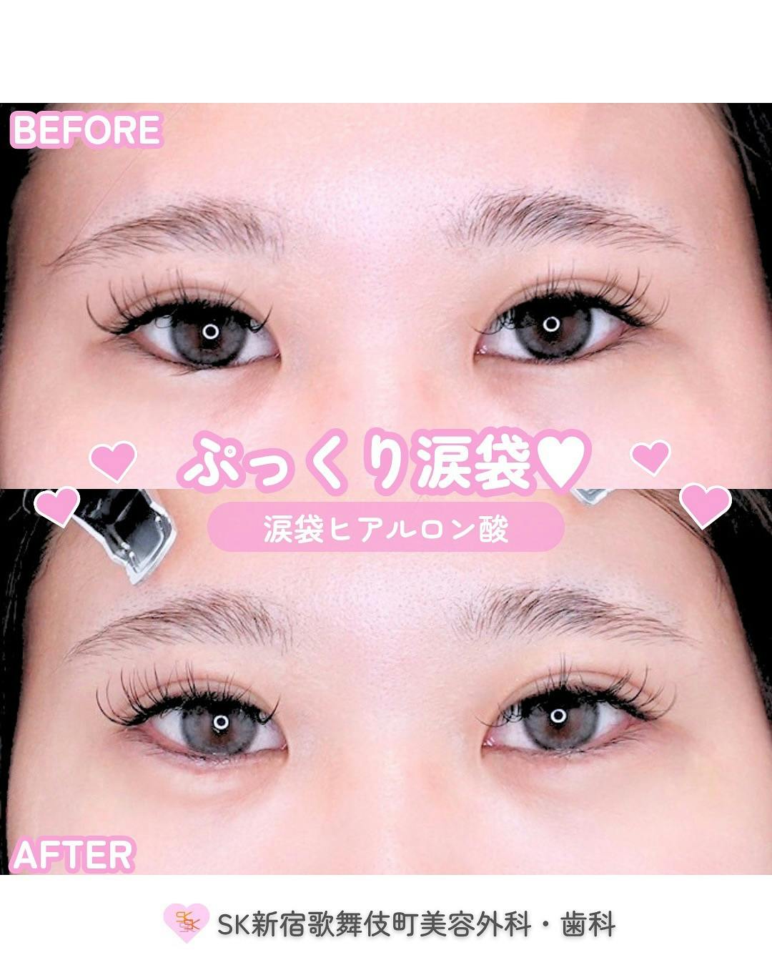 【女性・目元】涙袋ヒアルロン酸_before_aftar