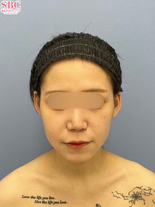 【女性・輪郭】Aquicell（アキーセル）脂肪吸引、根こそぎVASER脂肪吸引、ジョールファット除去術_aftar