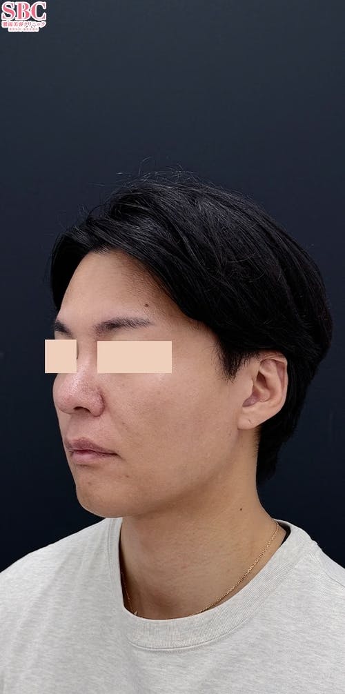 【40代男性・輪郭】Aquicell（アキーセル）脂肪吸引、ジョールファット除去術、根こそぎVASER脂肪吸引_after