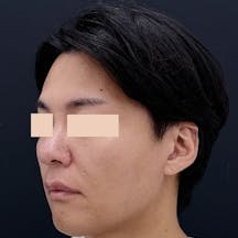 【40代男性・輪郭】Aquicell(アキーセル)脂肪吸引、ジョールファット除去術、根こそぎVASER脂肪吸引_after