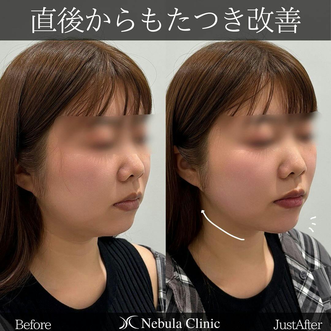 【女性・顔・顎】ヒアルロン酸注入(顎)、医療ハイフ_before_aftar