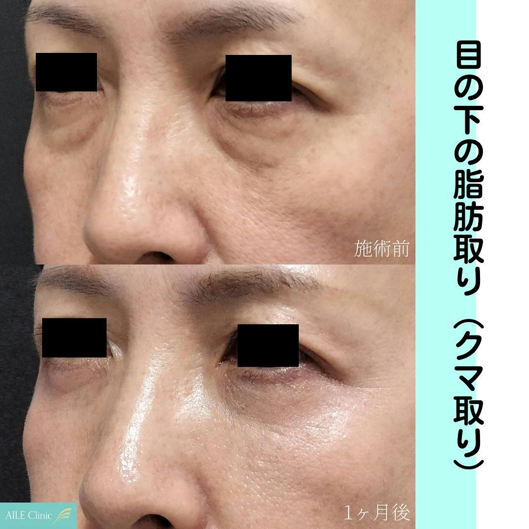 【女性・クマ】目の下の脂肪取り(クマ取り)_before_aftar