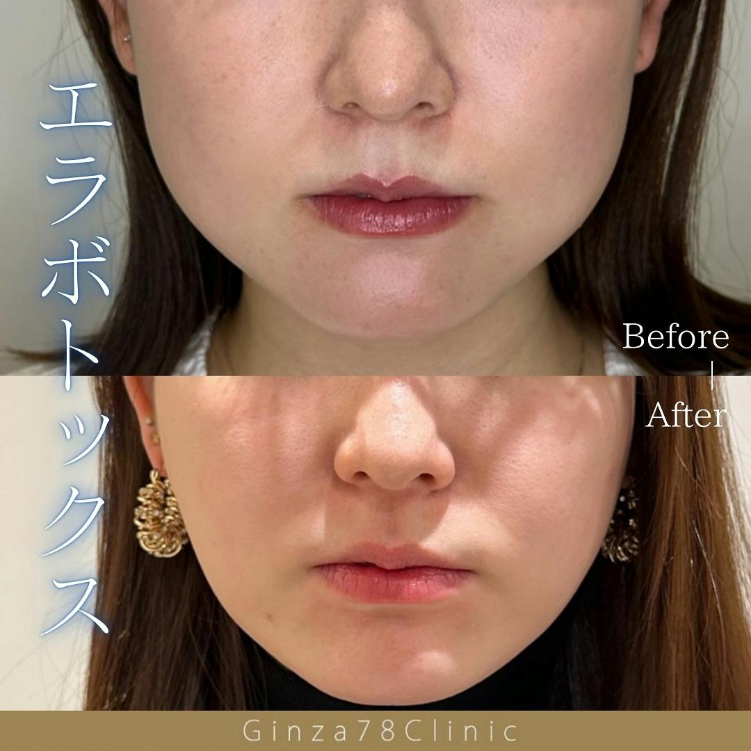 【女性・小顔】ボトックス_before_aftar