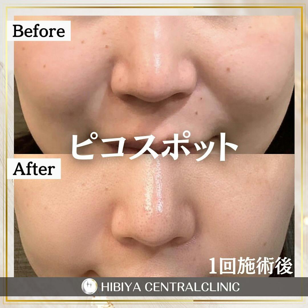 【女性・シミ】ピコスポット_before_aftar