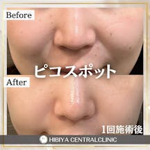 【女性・シミ】ピコスポット_before_aftar