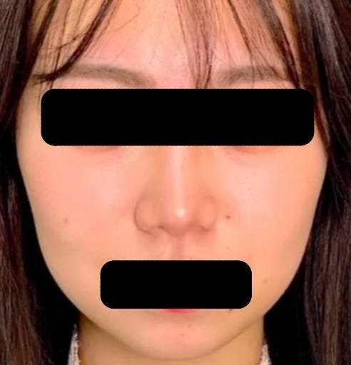 湘南美容クリニック 新橋銀座口院で鼻整形：小鼻縮小術（鼻翼縮小）を受けたウィンさんの写真