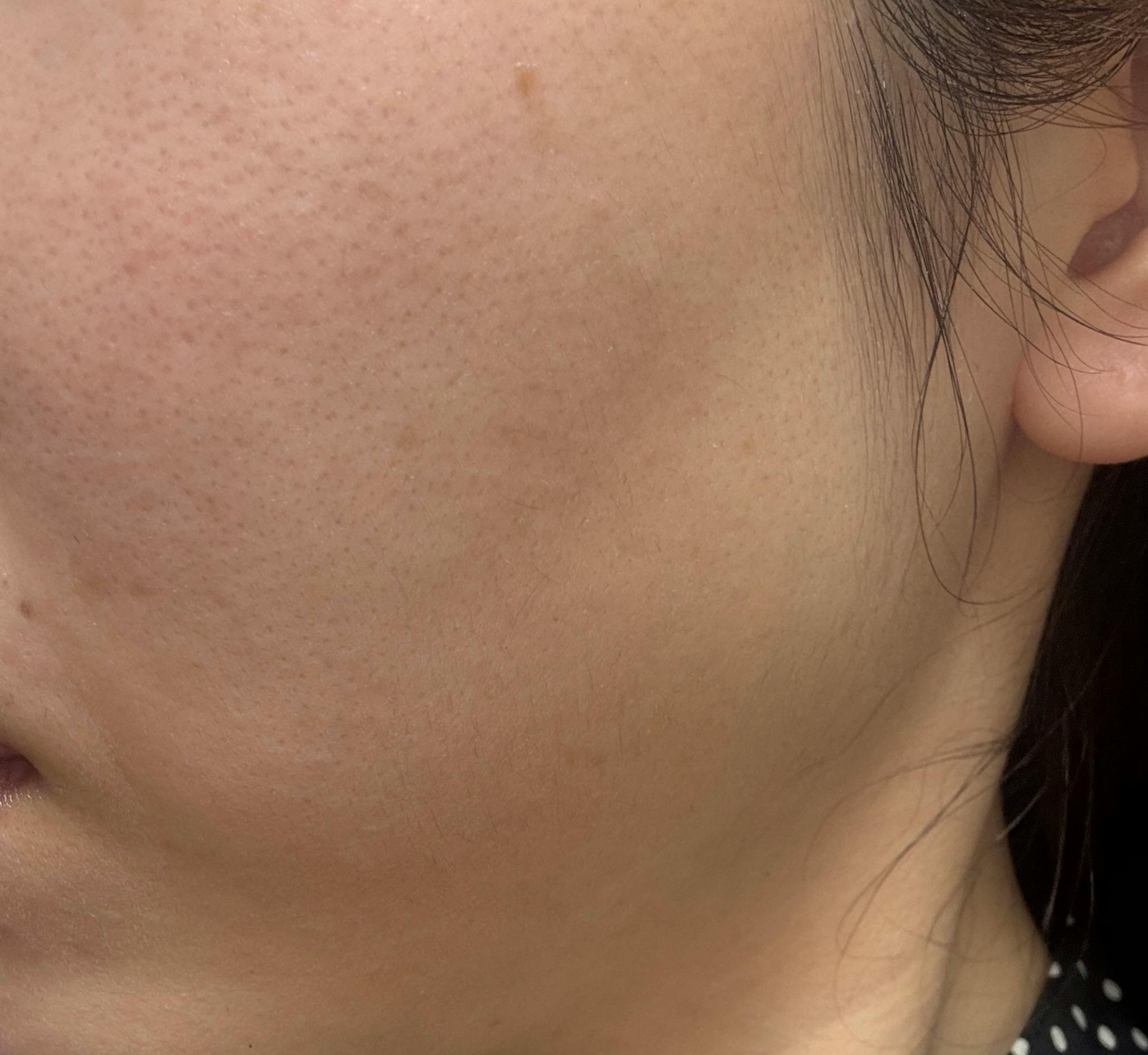 湘南美容クリニック 上野院でIPL光治療(フォトフェイシャル)・フォトフェイシャルステラM22・医療レーザー治療・ノーニードルセラピー・エレクトロポレーション・ケミカルピーリング・サリチル酸マクロゴールピーリング・ピーリング・ピーリング(ボディ)を受けたnaoさんの写真